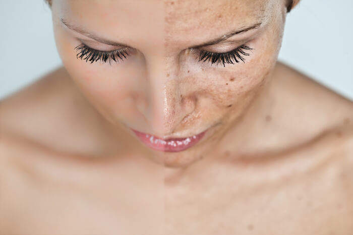 Пилинг, ультразвуковой пилинг, химический, молочный AlmaBeauty