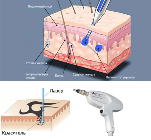 удаление тату лазером